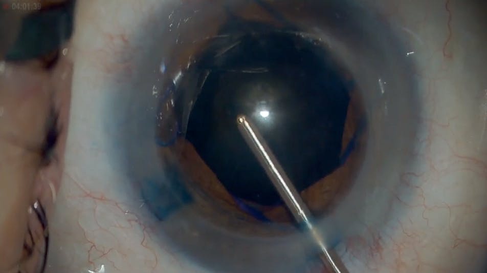 Black Cataract Modified Extracapsular Technique With Miloop Eyetube 4530